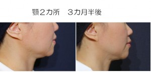 クルスカ顎２