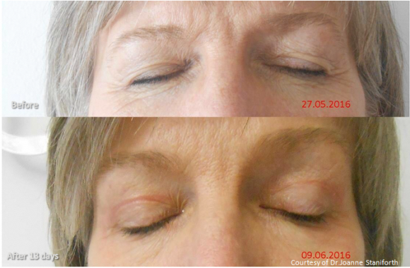 上眼瞼4 施術前_1回13日後